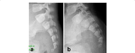 Coccyx X Ray Positioning - RoderickknoeJoyce