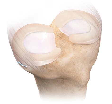 Arthrex - Knee Capsule Repair Surgical Technique