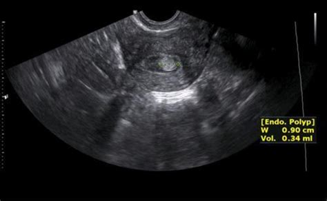 FIBROIDS, POLYPS AND UTERINE DISEASE - Parker, CO: Rocky Mountain ...