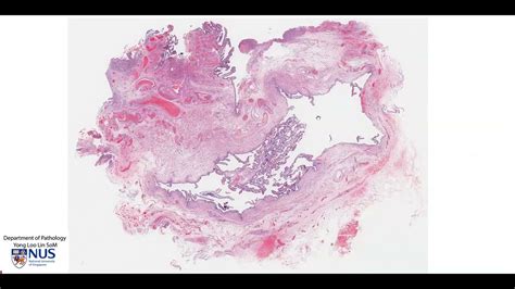 Fallopian tube - Hydrosalpinx microscopy - Talking slide - YouTube