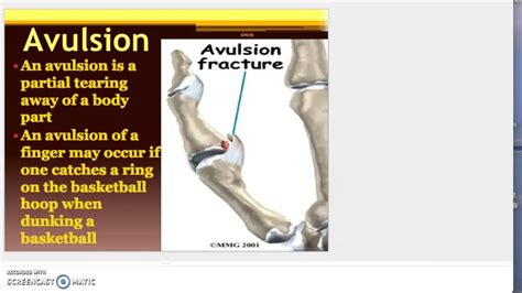 Types of Soft Tissue Injuries - YouTube