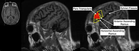 Triangularis Anatomy