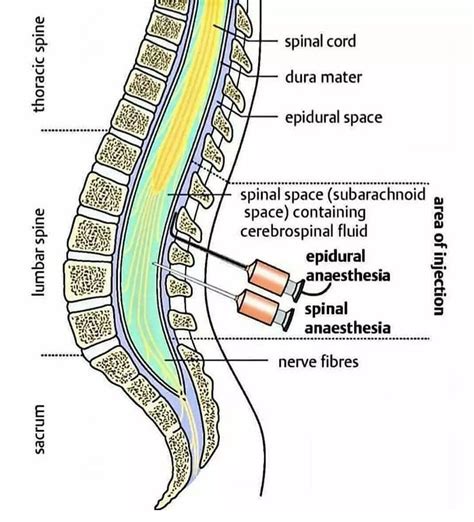 Epidural and Spinal Anaesthesia - MEDizzy