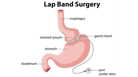 What to Expect After Lap-Band Surgery | Expectation After Lap Band Surgery