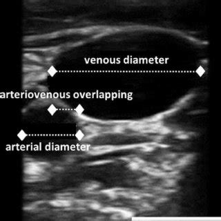 1-Innominate Vein, 2-Internal Jugular Vein, 3-Supraclavicular Vein,... | Download Scientific Diagram