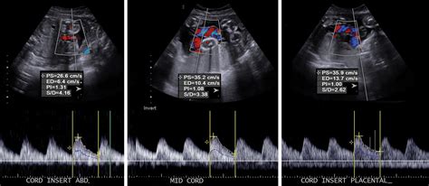 A Radiologist’s Guide to the Performance and Interpretation of Obstetric Doppler US | RadioGraphics