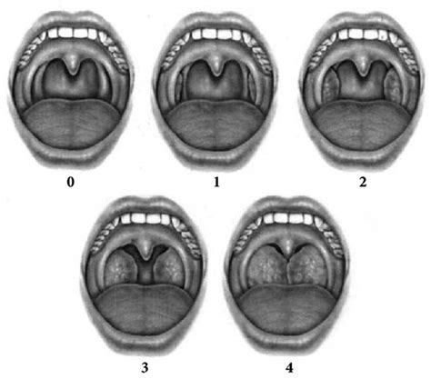 Tonsillitis - Francis De Castro, Ishtiak Mahamud, Joshua Garg, Hussein Walijee, 2023