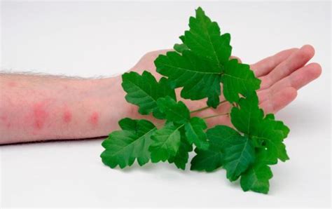 Poison Oak Allergy Symptoms