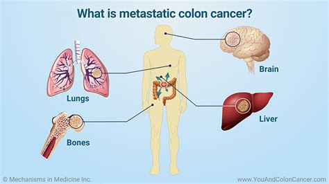 What is Colon Cancer?