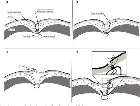 Figure 2 from Excision and suture in the midline versus Karydakis flap ...