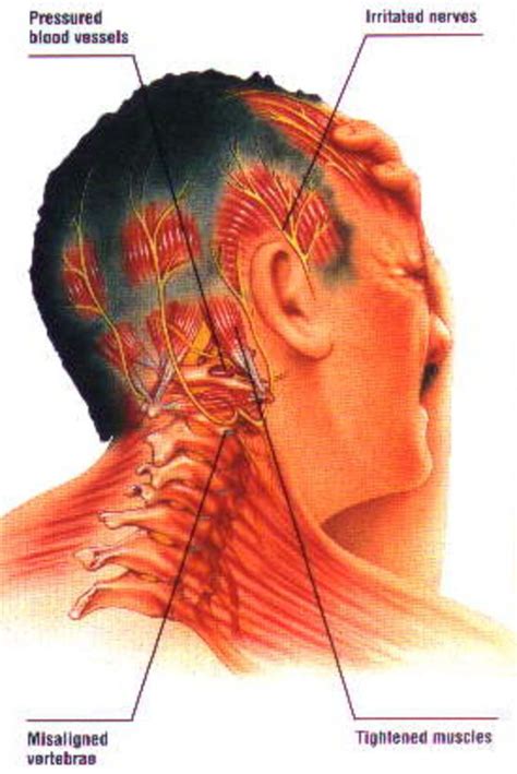 Can Neck and Spine Misalignment Cause Migraines? | Headache types, Headache treatment, Migraine ...