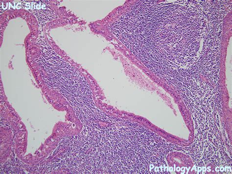 warthin tumor pathology