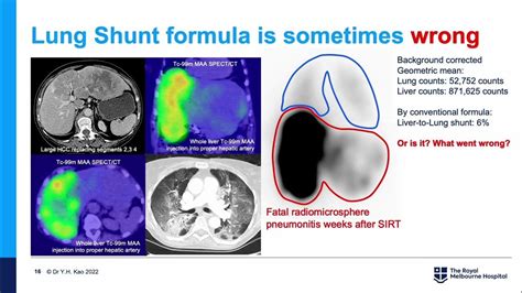 Yttrium-90 Radioembolization Selective Internal Radiation Therapy Y90 SIRT Radioembolisation ...