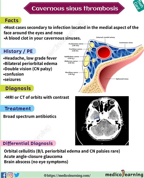 Cavernous sinus thrombosis flash card | Medical school essentials ...