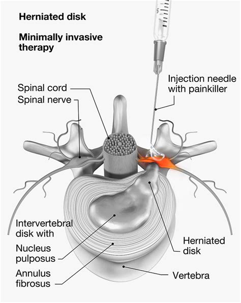 Nerve Root Block | Back Pain | Transforaminal Epidural | Bristol, Bath, Somerset | Bristol Spine ...