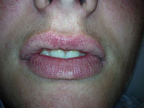 How To Get Rid Of Fordyce Spots On Your Lips - Infoupdate.org