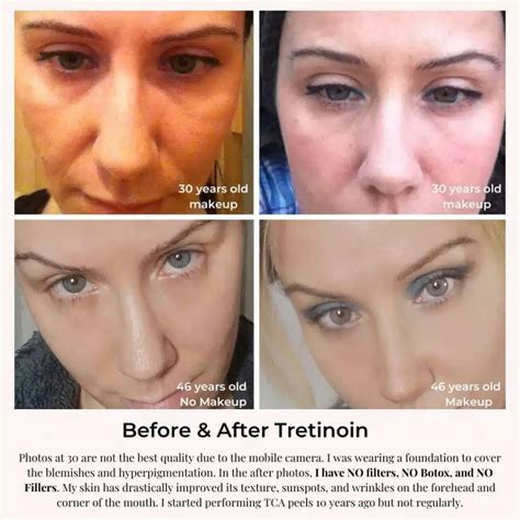 RETIN-A / Tretinoin For Wrinkles: Review & Before and After!