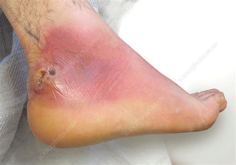 Foot Abscess - Stock Image - C009/4809 - Science Photo Library