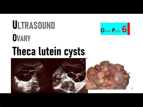 Theca Luteum Cyst