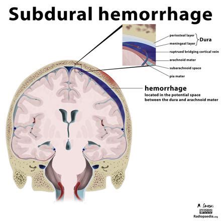 [Neuroanatomy(2)meningeal structure] EDH vs SDH vs SAH : 네이버 블로그