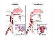 Intubation vs. Tracheostomy Medical Exhibit Medivisuals