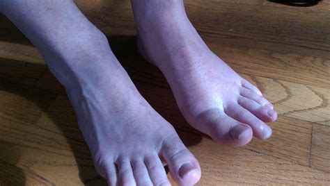 Gout – The Natural Approach That Works – GAPS Protocol Help