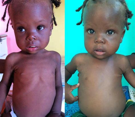 Malnutrition Treatment – Children's Health Ministries