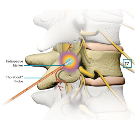 Sacroiliac Joint Radiofrequency Ablation