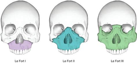 Facial Fractures – Core EM