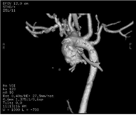 Figure 1 from Glidescope intubation after failed fiberoptic intubation ...