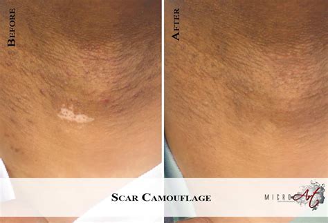 Scar Treatment By MicroArt Semi Permanent Scar Camouflage