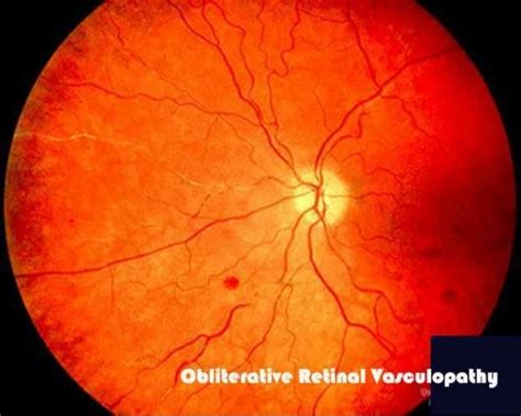 Fundus examination