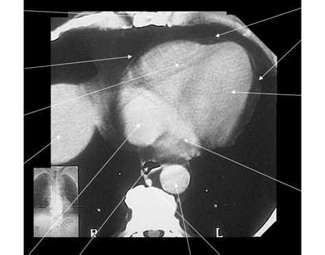 Mediastinum CT scan 3 Quiz