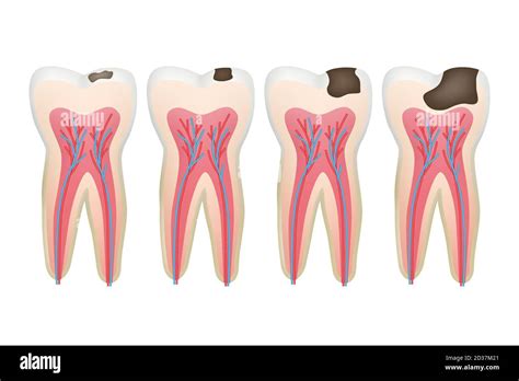 Dental Caries Treatment