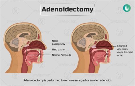 Adenoidectomy: Procedure, Purpose, Results, Cost, Price