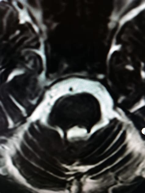 Progressive Supranuclear Palsy: MRI - Sumer's Radiology Blog