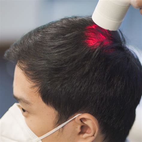 Laser Therapy for Hair Growth | Svenson