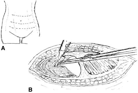 Feasibility of the Maylard transverse incision for ovarian cancer cytoreductive surgery ...