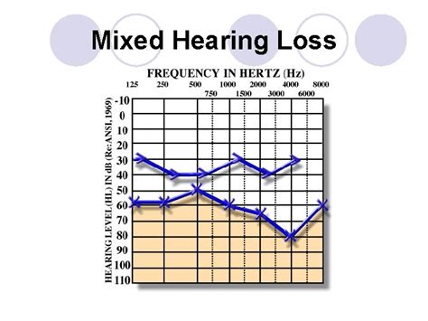 Reading an Audiogram Air vs Bone Conduction l