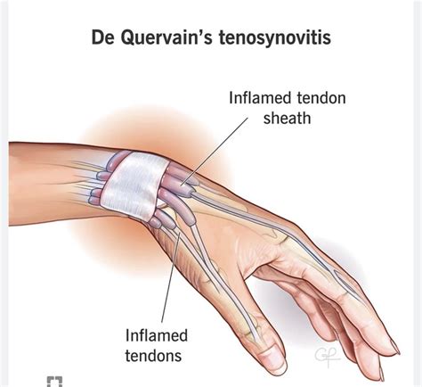 De Quervain tenosynovitis : r/newborns