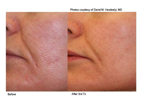 Shrink Large Pores - T. Douglas Gurley MD