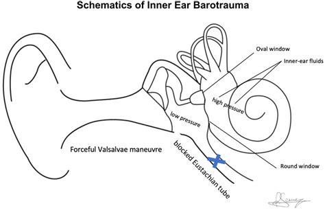 Schematic diagram of inner ear barotrauma: pressure increases during... | Download Scientific ...