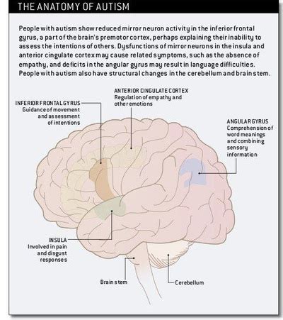 Autism or Kanner's Syndrome (classic autistic disorder) - disability speaks website