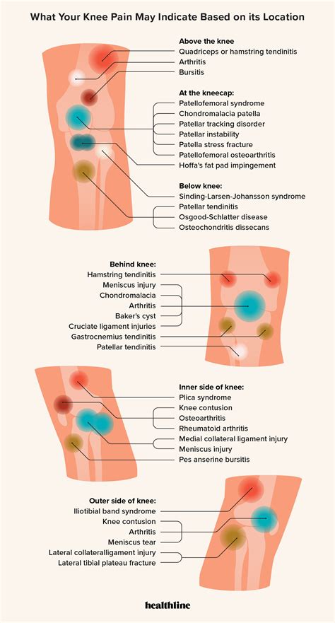 Knee Pain Location Chart: What Knee Pain May Indicate, 59% OFF