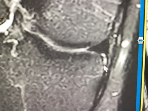 Knee MRI coronary ligament Diagram | Quizlet