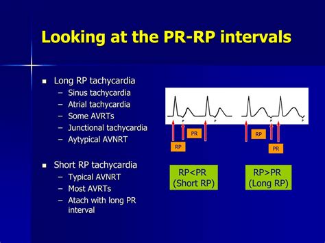 PPT - Tachyarrhythmia: Pearls for ECG Diagnosis PowerPoint Presentation - ID:474139