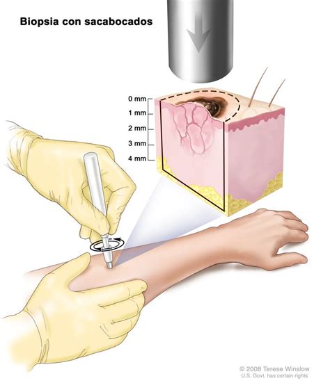 Tratamiento del cáncer de piel - NCI