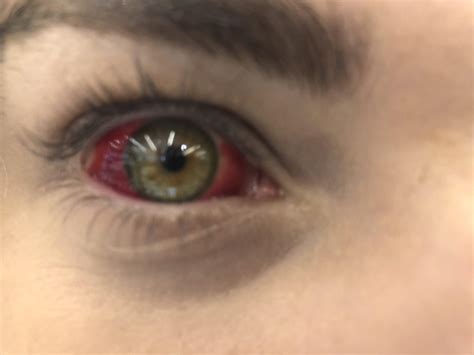 My friend has a burst blood vessel in her eye 😱 : r/eyes