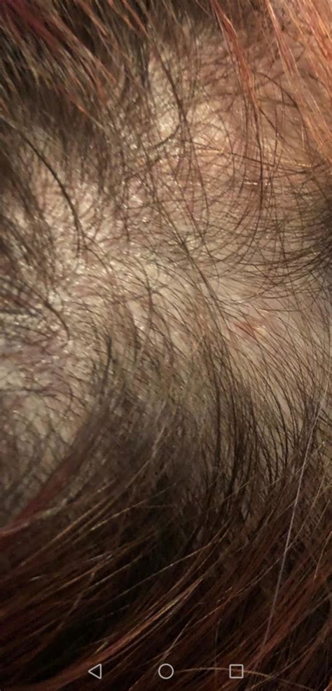 Shingles on scalp or not? | Shingles | Forums | Patient