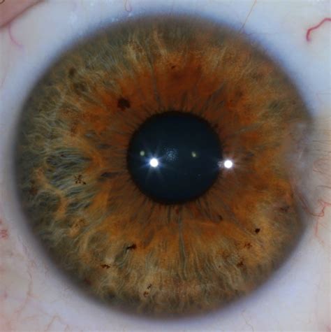 Modern & Multidimensional Iridology: The Assessment of Iris Pigmentation - Rx - (sus)